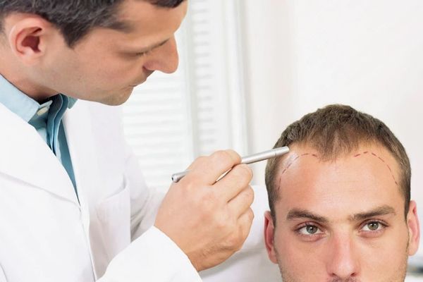 Injerto de cabello - Tricólogo diseñando la línea de implantación frontal para realizar un injerto cabello CDMX