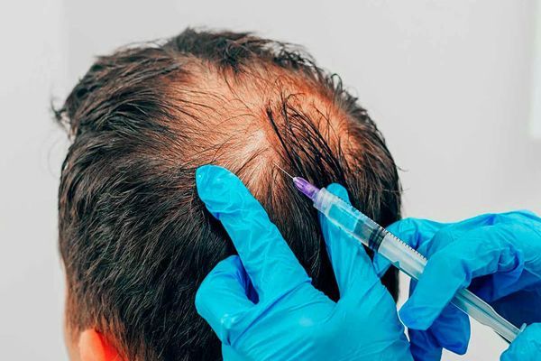 Doctora aplica plasma rico en plaqueta para estimular la oxigenación de los folículos pilosos en la zona de la coronilla
