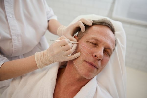Dermatólogos en CDMX - Especialista en tratamientos dermoestéticos traza líneas guías para insertar hilos tensores 