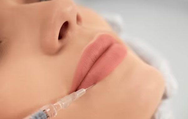 aumento de labios - Mujer recibe un relleno facial para restaurar el volumen de los labios