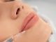 aumento de labios - Mujer recibe un relleno facial para restaurar el volumen de los labios