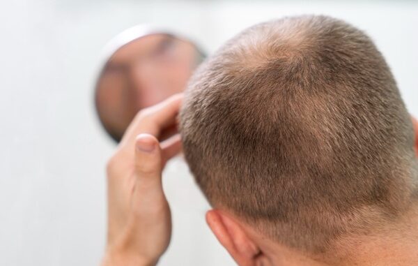 Trasplante de cabello - Hombre observando en un espejo el avance de la alopecia considerando un injerto de cabello CDMX