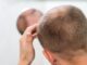 Trasplante de cabello - Hombre observando en un espejo el avance de la alopecia considerando un injerto de cabello CDMX