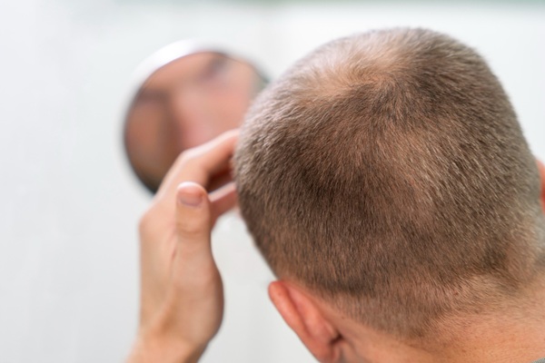 Trasplante de cabello - Hombre observando en un espejo el avance de la alopecia considerando un injerto de cabello CDMX