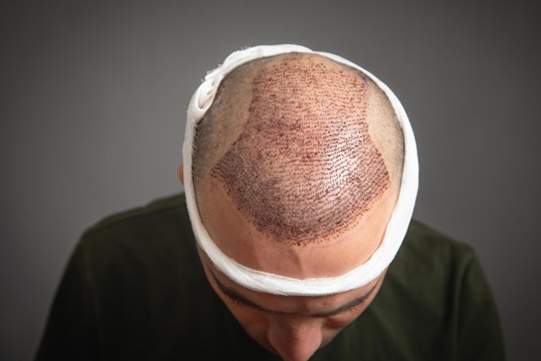 Trasplante de cabello - Hombre con un injerto capilar recién hecho en la Ciudad de México