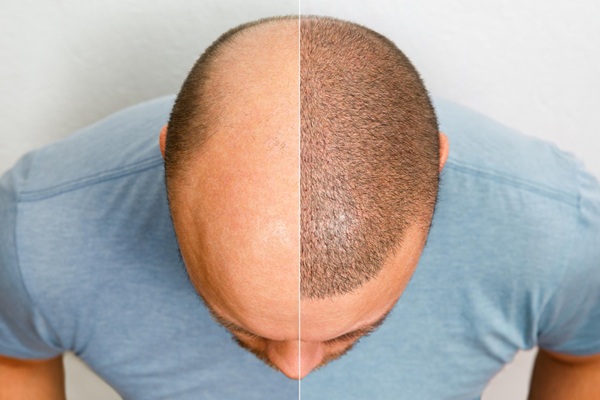 Trasplante de cabello - Imagen comparativa de la evolución del injerto de cabello CDMX