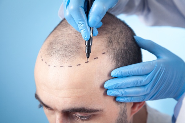 Trasplante de cabello - Médico tricólogo realizando el diseño del implante capilar CDMX para determinar cuánto cuesta un injerto de cabello